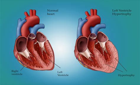 severe eccentric left ventricular hypertrophy